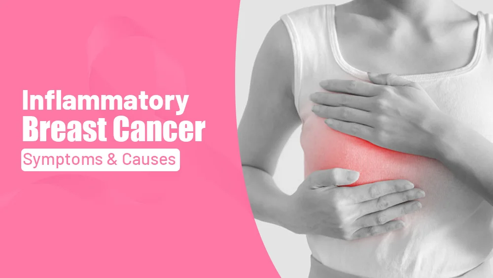 What Is Breast Cancer? Causes, Stages, Treatment & Survival Rates